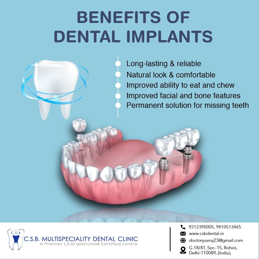 Need For dental implant in rohini sector 15, Delhi